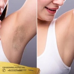 Laser hair removal