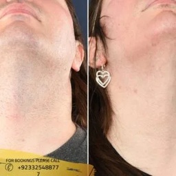 Laser hair removal