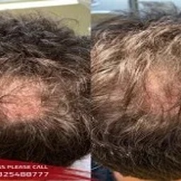 PRP Treatment In Islamabad