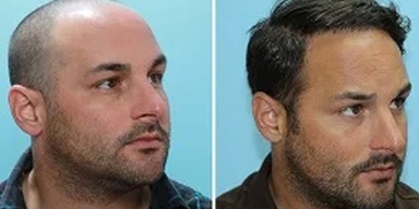 Dynamic Hair Transplant Islamabad