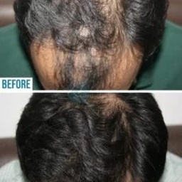 Hair Transplant Company