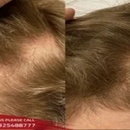 PRP Treatment In Islamabad