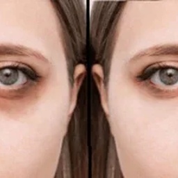 Dark Circle Treatment in Dubai