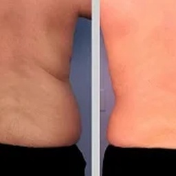 Laser Liposuction Treatment In Islamabad