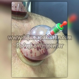 UG Healing Center Hijama Clinic