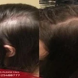 PRP Treatment In Islamabad