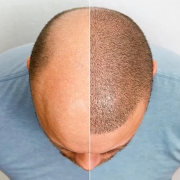Cheap Hair Transplant Clinic Pakistan