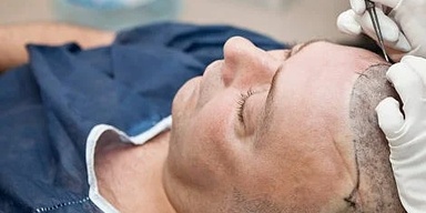 Cheap Hair Transplant Clinic Pakistan