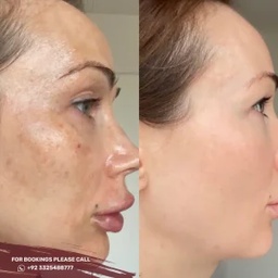Skin Whitening in islamabad