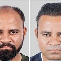 Dynamic Hair Transplant Islamabad