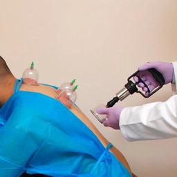 Health With Hijama Therapy