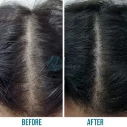 Hair Transplant Company