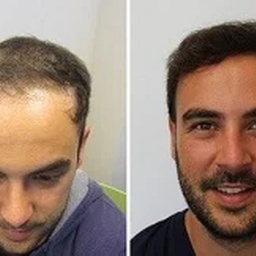 Dynamic Hair Transplant Islamabad