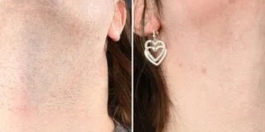 Laser hair removal