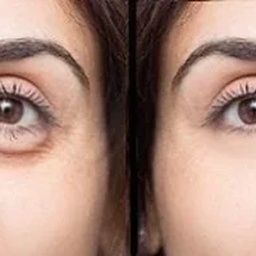 Dark Circle Treatment in Dubai