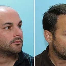 Dynamic Hair Transplant Islamabad