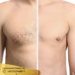 Laser hair removal