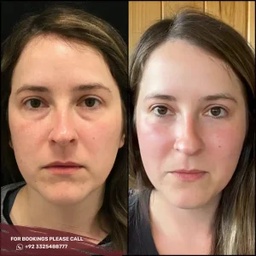 Skin Whitening in islamabad